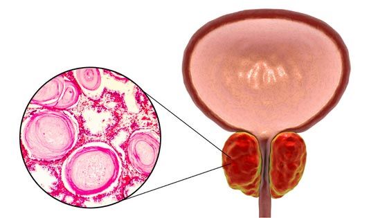 Prostatavergrößerung