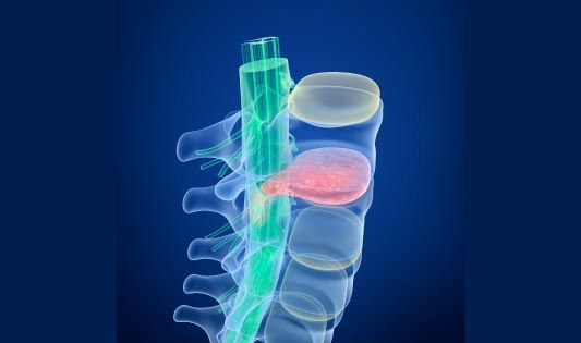 Spinalkanalstenose