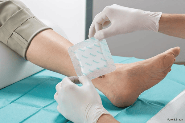 Feuchte Wundversorgung mit Schaumverband durch Krankenpfleger