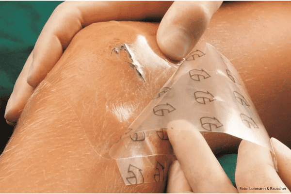 Folienverband Anwendung auf Knie