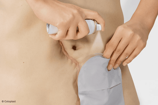 Pflasterentferner Spray Anwendung Entfernung Stoma Basisplatte mit Beutel