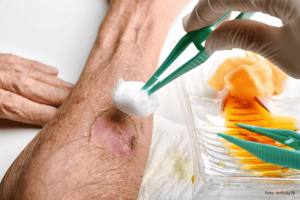 Wunde wird mit Wundmaterial versorgt