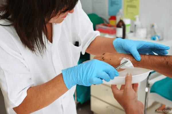 Sekundäre Wundversorgung einer chronischen Wunde an der Hand durch Ärztin / Krankenschwester
